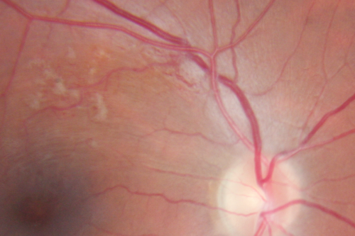 Twig Branch Retinal Vein Occlusion - Recurrent Macular Edema with extended interval Lucentis Therapy after first 6 monthly Injections
39-year-old man has a macular branch retinal vein occlusion with macular edema.  He had an excellent response to Lucentis for his first 6 treatments.  He was last here 6 weeks ago and his vision seems OK to him.  OD 20/40. 
