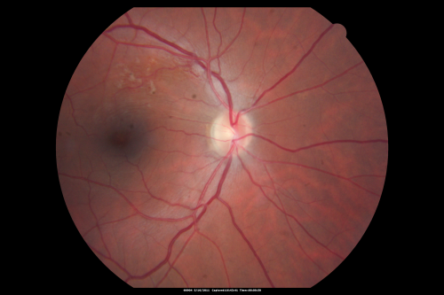 Twig Branch Retinal Vein Occlusion - Recurrent Macular Edema with extended interval Lucentis Therapy after first 6 monthly Injections
39-year-old man has a macular branch retinal vein occlusion with macular edema.  He had an excellent response to Lucentis for his first 6 treatments.  He was last here 6 weeks ago and his vision seems OK to him.  OD 20/40. 
