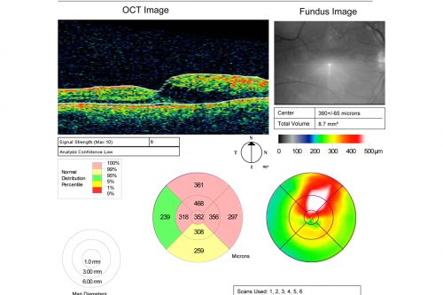 Twig Branch Retinal Vein Occlusion - Recurrent Macular Edema with extended interval Lucentis Therapy after first 6 monthly Injections
39-year-old man has a macular branch retinal vein occlusion with macular edema.  He had an excellent response to Lucentis for his first 6 treatments.  He was last here 6 weeks ago and his vision seems OK to him.  OD 20/40. 
