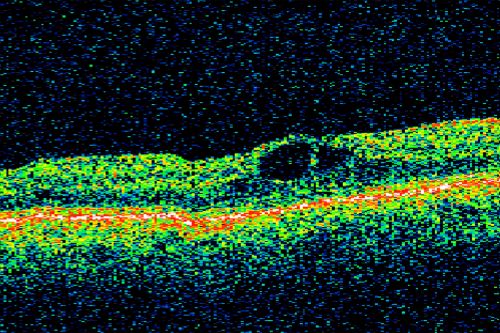 Twig Branch Retinal Vein Occlusion - Recurrent Macular Edema with extended interval Lucentis Therapy after first 6 monthly Injections
39-year-old man has a macular branch retinal vein occlusion with macular edema.  He had an excellent response to Lucentis for his first 6 treatments.  He was last here 6 weeks ago and his vision seems OK to him.  OD 20/40. 

