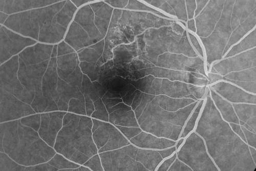 Twig Branch Retinal Vein Occlusion - Recurrent Macular Edema with extended interval Lucentis Therapy after first 6 monthly Injections
39-year-old man has a macular branch retinal vein occlusion with macular edema.  He had an excellent response to Lucentis for his first 6 treatments.  He was last here 6 weeks ago and his vision seems OK to him.  OD 20/40. 
