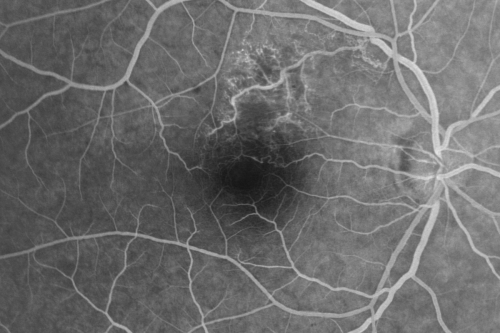 Twig Branch Retinal Vein Occlusion - Recurrent Macular Edema with extended interval Lucentis Therapy after first 6 monthly Injections
39-year-old man has a macular branch retinal vein occlusion with macular edema.  He had an excellent response to Lucentis for his first 6 treatments.  He was last here 6 weeks ago and his vision seems OK to him.  OD 20/40. 
