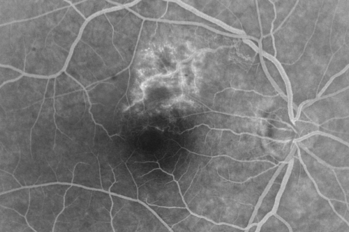 Twig Branch Retinal Vein Occlusion - Recurrent Macular Edema with extended interval Lucentis Therapy after first 6 monthly Injections
39-year-old man has a macular branch retinal vein occlusion with macular edema.  He had an excellent response to Lucentis for his first 6 treatments.  He was last here 6 weeks ago and his vision seems OK to him.  OD 20/40. 
