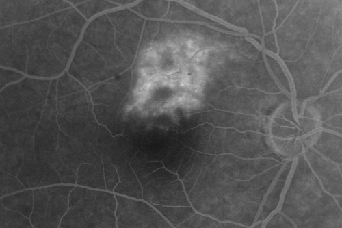 Twig Branch Retinal Vein Occlusion - Recurrent Macular Edema with extended interval Lucentis Therapy after first 6 monthly Injections
39-year-old man has a macular branch retinal vein occlusion with macular edema.  He had an excellent response to Lucentis for his first 6 treatments.  He was last here 6 weeks ago and his vision seems OK to him.  OD 20/40. 
