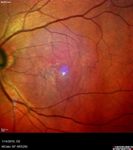 Twig Old  Macular Branch Retinal Vein Occlusion - Venous Venous Collaterals
88 year old man with 20/25 vision in his left and only eye.  There is vascular remodeling consistent with an old twig BRVO.
