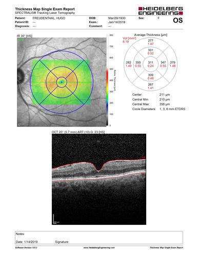 Twig Old  Macular Branch Retinal Vein Occlusion - Venous Venous Collaterals
88 year old man with 20/25 vision in his left and only eye.  There is vascular remodeling consistent with an old twig BRVO.

