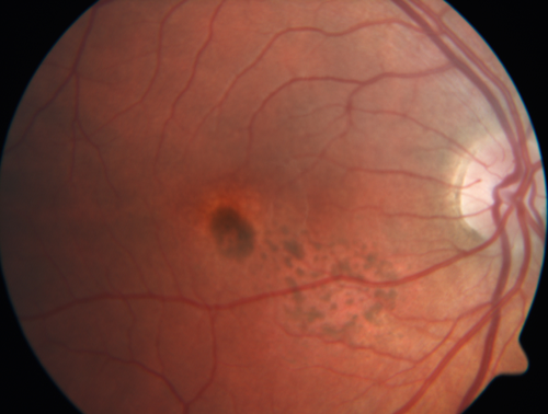 Unilteral Acute Idiopathic Maculopathy - 2 weeks following other images
