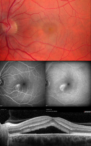 Unilateral acute idiopathic maculopathy
44 year old man One week ago the left eye was running non-stop and it burned and he had to pry the eye open.  Then the vision started to decline three days ago.  When he closes the right eye to look at something bright he cannot read.  He had a chest infection started about 2-3 weeks ago.  He saw a doctor on Monday 4 days ago.  He was started on an antibiotic but has not started it yet.  He did sore on the right side of his mouth with the infection and he did not have any rashes.  He does not have exposure 
