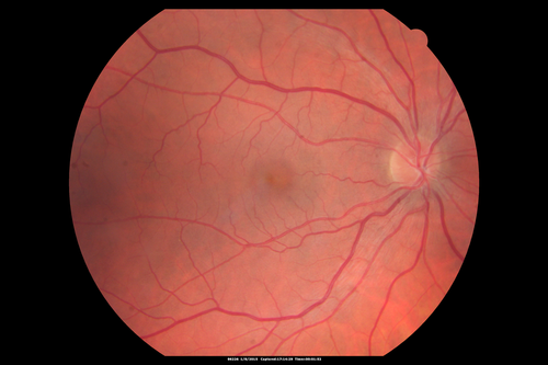Unilateral Acute Idiopathic Maculopathy (UAIM)
Normal right eye
