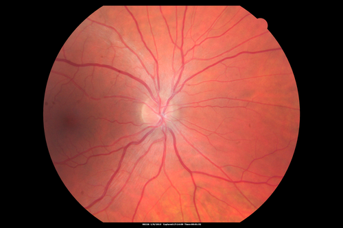 Unilateral Acute Idiopathic Maculopathy (UAIM)
Normal right eye

