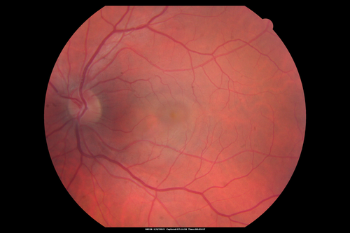 Unilateral Acute Idiopathic Maculopathy (UAIM)
41 year old with serous retinal detachment OS and sudden vision loss.  He had a viral prodrome.  Coxscackie IgG was high but no acute infection was documented.  Vision improved in about 2 months without therapy.
