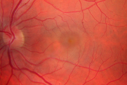 Unilateral Acute Idiopathic Maculopathy (UAIM)
41 year old with serous retinal detachment OS and sudden vision loss.  He had a viral prodrome.  Coxscackie IgG was high but no acute infection was documented.  Vision improved in about 2 months without therapy.
