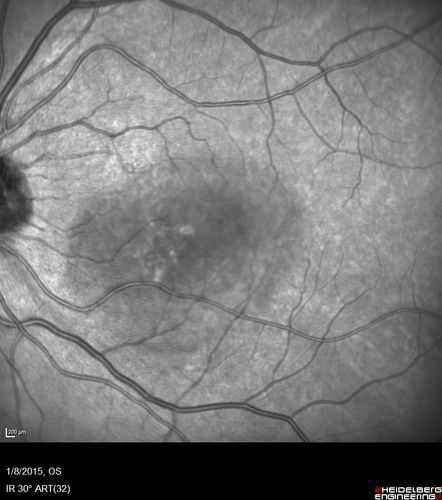 Unilateral Acute Idiopathic Maculopathy (UAIM)
41 year old with serous retinal detachment OS and sudden vision loss.  He had a viral prodrome.  Coxscackie IgG was high but no acute infection was documented.  Vision improved in about 2 months without therapy.
