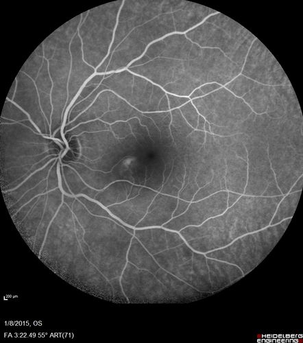 Unilateral Acute Idiopathic Maculopathy (UAIM)
41 year old with serous retinal detachment OS and sudden vision loss.  He had a viral prodrome.  Coxscackie IgG was high but no acute infection was documented.  Vision improved in about 2 months without therapy. - Right eye has spot nasal to the optic nerve
