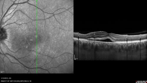 Unilateral Acute Idiopathic Maculopathy (UAIM)
1 week later eye looks better (after initial scan)  41 year old with serous retinal detachment OS and sudden vision loss.  He had a viral prodrome.  Coxscackie IgG was high but no acute infection was documented.  Vision improved in about 2 months without therapy. - Right eye has spot nasal to the optic nerve
