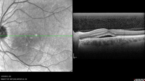 Unilateral Acute Idiopathic Maculopathy (UAIM)
Vision has improved back to 20/20 without any therapy.  1 month following vision loss
