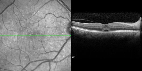 Choroidal Effusions and Serous retinal detachment with Systemic Testosterone and Cialis in 75 year old Man
SD OCT shows choroidal thickening and subretinal fluid
