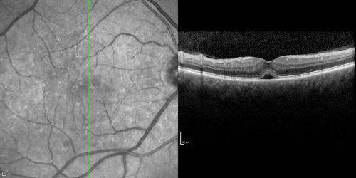 Choroidal Effusions and Serous retinal detachment with Systemic Testosterone and Cialis in 75 year old Man
SD OCT shows choroidal thickening and subretinal fluid
