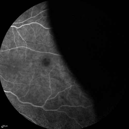 Choroidal Effusions and Serous retinal detachment with Systemic Testosterone and Cialis in 75 year old Man
Fluorescein angiogram shows some staining of the disk - confocal system renders peripheral effusions black
