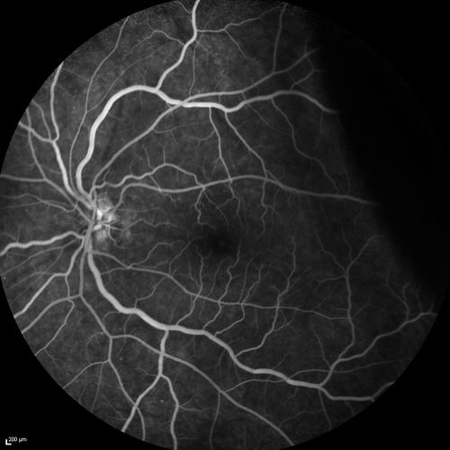 Choroidal Effusions and Serous retinal detachment with Systemic Testosterone and Cialis in 75 year old Man
Fluorescein angiogram shows some staining of the disk - confocal system renders peripheral effusions black
