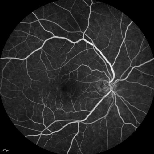 Choroidal Effusions and Serous retinal detachment with Systemic Testosterone and Cialis in 75 year old Man
Fluorescein angiogram shows some staining of the disk

