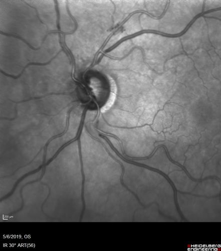 Venous Anomaly - 80 year old female - normal vision

