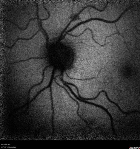 Venous Anomaly - 80 year old female - normal vision
