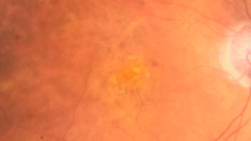 Venous Macroaneurysm 6 year old CRVO - treated with focal laser
93 year old female with CRVO in the right eye 6 years ago.  The visual potential is 20/100 and has recently subjectively and objectively declined.  VA is 20/200 and she has new onset macular edema from a venous macroaneurysm that formed at a collateral vessel.  This responded nicely to a single laser spot.
