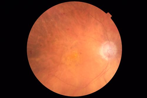 Venous Macroaneurysm 6 year old CRVO - treated with focal laser
93 year old female with CRVO in the right eye 6 years ago.  The visual potential is 20/100 and has recently subjectively and objectively declined.  VA is 20/200 and she has new onset macular edema from a venous macroaneurysm that formed at a collateral vessel.  This responded nicely to a single laser spot.
