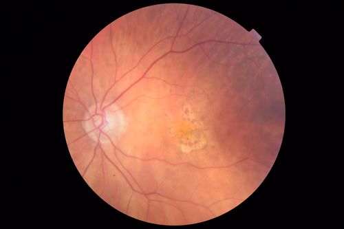 Venous Macroaneurysm 6 year old CRVO - treated with focal laser
93 year old female with CRVO in the right eye 6 years ago.  The visual potential is 20/100 and has recently subjectively and objectively declined.  VA is 20/200 and she has new onset macular edema from a venous macroaneurysm that formed at a collateral vessel.  This responded nicely to a single laser spot.
