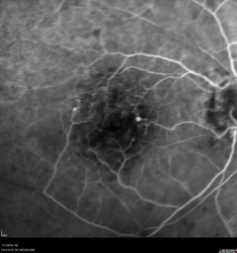 Venous Macroaneurysm 6 year old CRVO - treated with focal laser
93 year old female with CRVO in the right eye 6 years ago.  The visual potential is 20/100 and has recently subjectively and objectively declined.  VA is 20/200 and she has new onset macular edema from a venous macroaneurysm that formed at a collateral vessel.  This responded nicely to a single laser spot.
