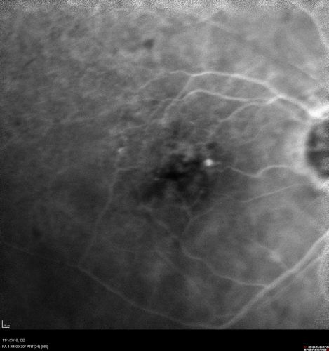Venous Macroaneurysm 6 year old CRVO - treated with focal laser
93 year old female with CRVO in the right eye 6 years ago.  The visual potential is 20/100 and has recently subjectively and objectively declined.  VA is 20/200 and she has new onset macular edema from a venous macroaneurysm that formed at a collateral vessel.  This responded nicely to a single laser spot.
