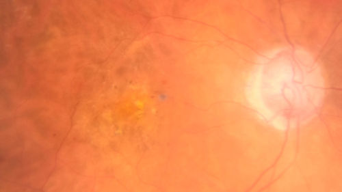 Venous Macroaneurysm 6 year old CRVO - treated with focal laser
93 year old female with CRVO in the right eye 6 years ago.  The visual potential is 20/100 and has recently subjectively and objectively declined.  VA is 20/200 and she has new onset macular edema from a venous macroaneurysm that formed at a collateral vessel.  This responded nicely to a single laser spot.
