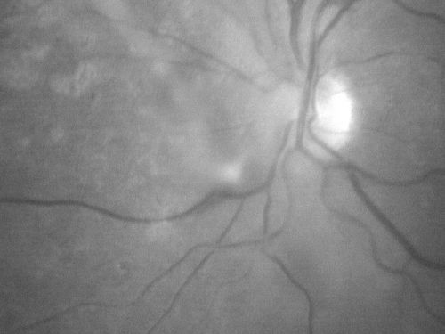 Regressed Proliferative Diabetic Retinopathy with Recurrent Vitreous Hemorrhage from Vitreoretinal Traction over a Major Retinal Vessel (Vein)
56-year-old woman has had recurrent vitreous hemorrhage in the left eye from vitreoretinal traction. Diabetes Mellitus for 20 years and excellent response to vitrectomy in the right eye about 1 year ago for recurrent vitreous hemorrhage from traction over a major retinal vessel.

VISUAL ACUITY:  Vision OS is 20/200

