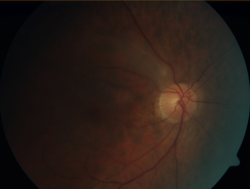 Retinal Capillary Hemangioma - Endophytic and Exophytic
46 year old female with normal vision - her father died of pancreatic cancer
