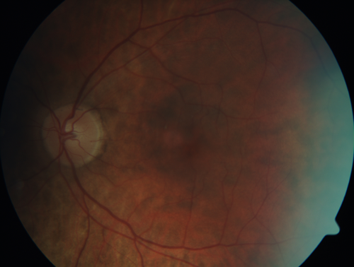 Retinal Capillary Hemangioma - Endophytic and Exophytic
46 year old female with normal vision - her father died of pancreatic cancer
