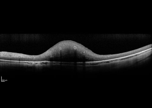 Retinal Capillary Hemangioma - Endophytic and Exophytic
46 year old female with normal vision - her father died of pancreatic cancer
