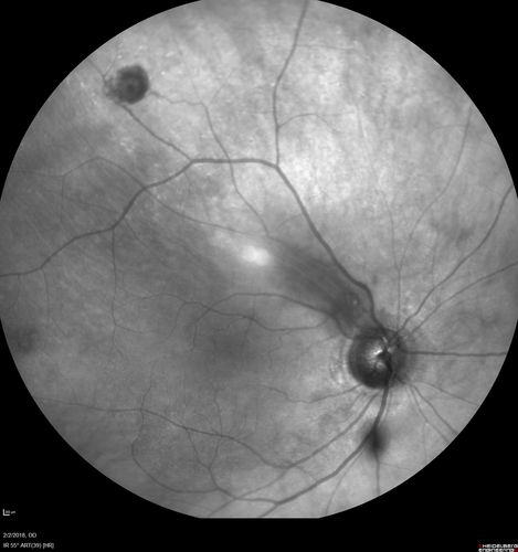Retinal Capillary Hemangioma - Endophytic and Exophytic
46 year old female with normal vision - her father died of pancreatic cancer
