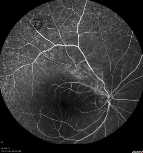 Retinal Capillary Hemangioma - Endophytic and Exophytic
46 year old female with normal vision - her father died of pancreatic cancer
