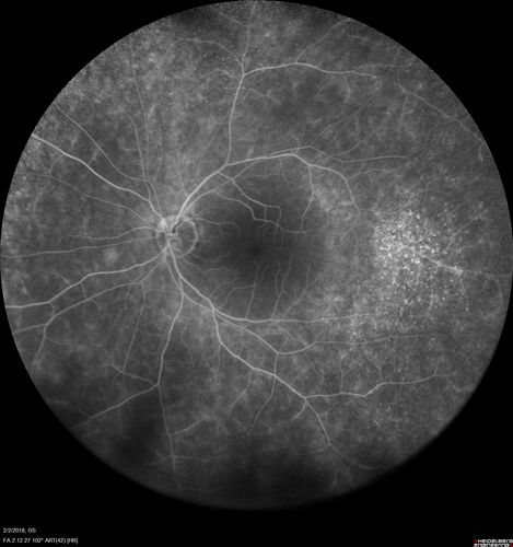 Retinal Capillary Hemangioma - Endophytic and Exophytic
46 year old female with normal vision - her father died of pancreatic cancer
