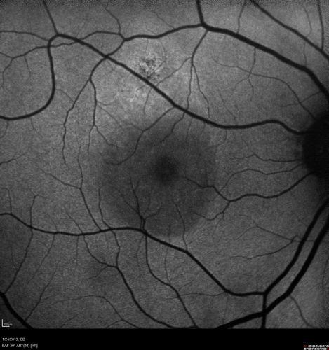 Chronic Central Serous Retinopathy - FAF
