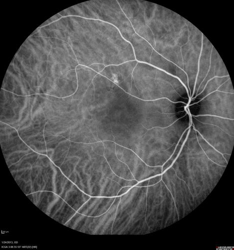 Chronic Central Serous Retinopathy - Indocyanine Green Angiogram 
