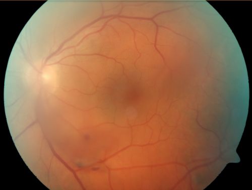 Vitreous Hemorrhage from Retinal Tear - Acute Posterior Vitreous Detachment
