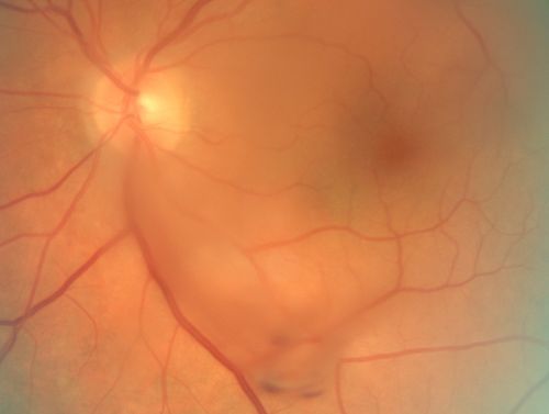 Vitreous Hemorrhage from Retinal Tear - Acute Posterior Vitreous Detachment
