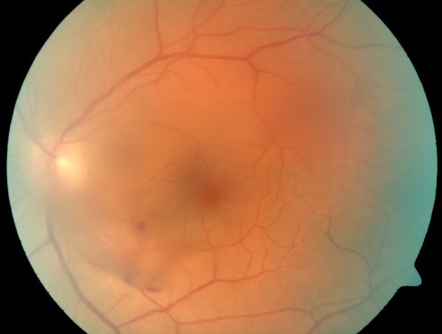 Vitreous Hemorrhage from Retinal Tear - Acute Posterior Vitreous Detachment

