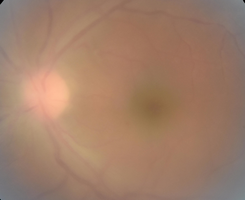 Toxoplasmosis - Recurrent - Moderate Vitritis
32 year old woman with 20/80 vision and moderately painful red eye in the left eye only.  The left eye had some redness about 10 years ago.  She is a native of Sierra Leone
