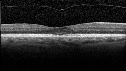 Vitreomacular traction OU - Aborted in 3 months - right eye 3 months f-u
62 year old female with blurred vision in both eyes for 2 months intermittently.  She was referred for macular edema.
A 20/32 OD, 20/25 OS
OCT showed VMT in one eye and edema in the other
3 months later in the last 2 OCT scans 
VA 20/20 OD, 20/16 OS and VMT had released.
