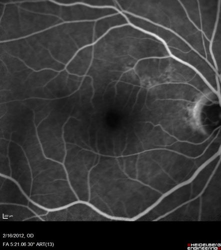 Vitreomacular traction - recent vision loss left eye - FA
