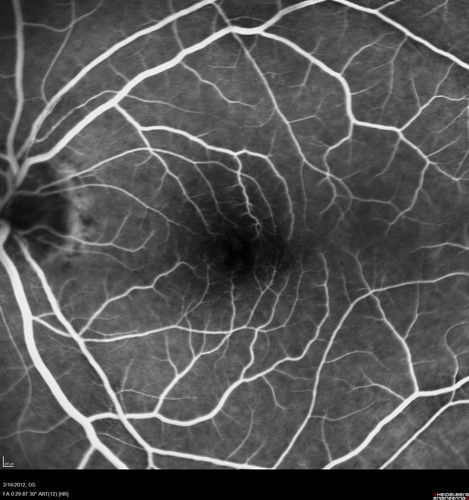 Vitreomacular traction - recent vision loss left eye - FA
