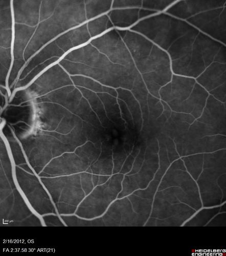 Vitreomacular traction - recent vision loss left eye - FA

